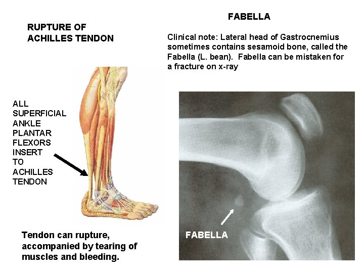 FABELLA RUPTURE OF ACHILLES TENDON Clinical note: Lateral head of Gastrocnemius sometimes contains sesamoid
