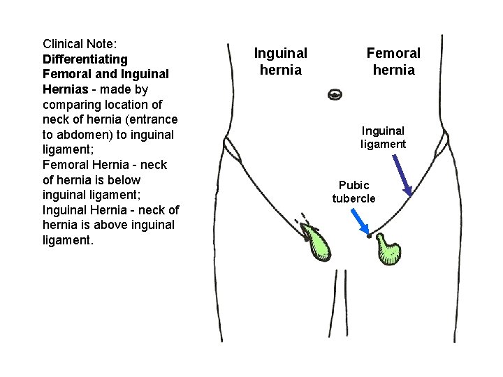 Clinical Note: Differentiating Femoral and Inguinal Hernias - made by comparing location of neck