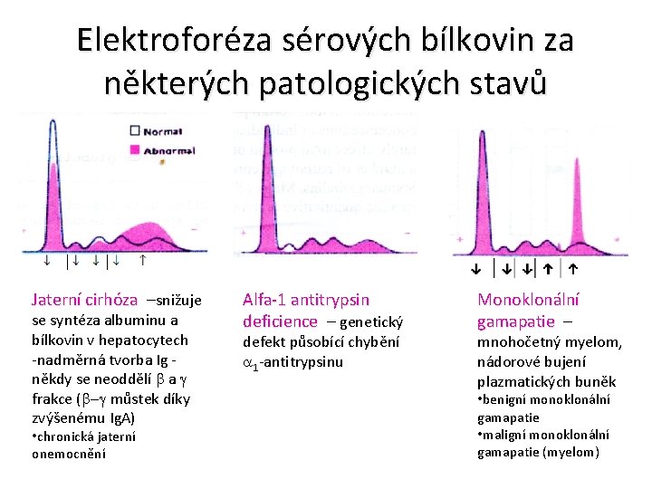 Elektroforéza sérových bílkovin za některých patologických stavů Jaterní cirhóza – Jaterní cirhóza snižuje se