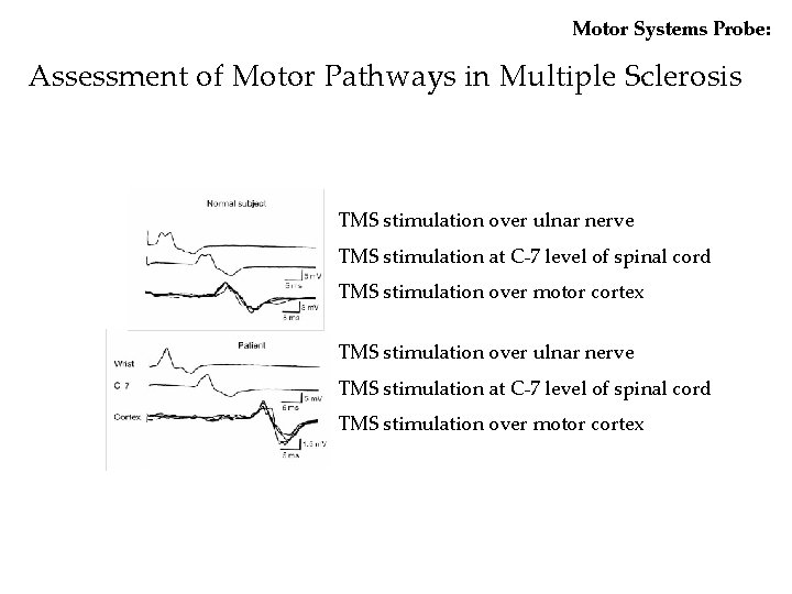 Motor Systems Probe: Assessment of Motor Pathways in Multiple Sclerosis TMS stimulation over ulnar Motor Systems Probe: Assessment of Motor Pathways in Multiple Sclerosis TMS stimulation over ulnar