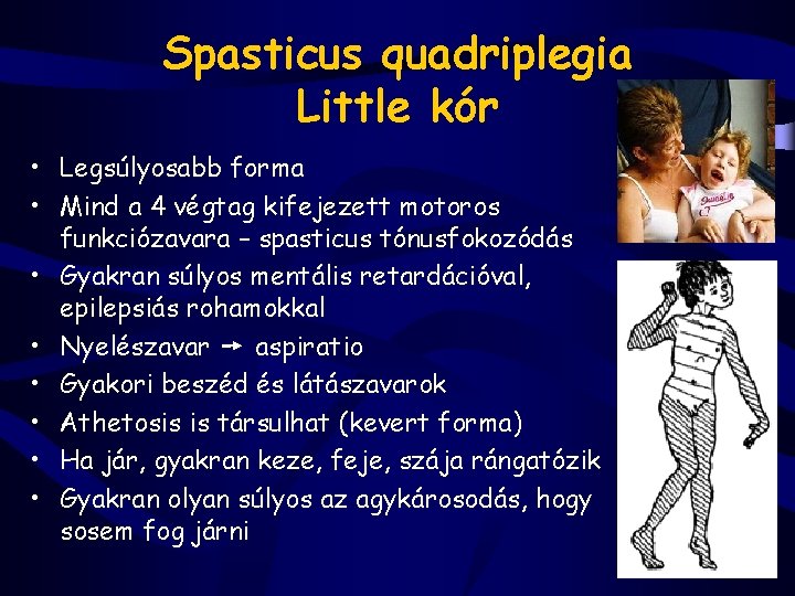 Spasticus quadriplegia Little kór • Legsúlyosabb forma • Mind a 4 végtag kifejezett motoros