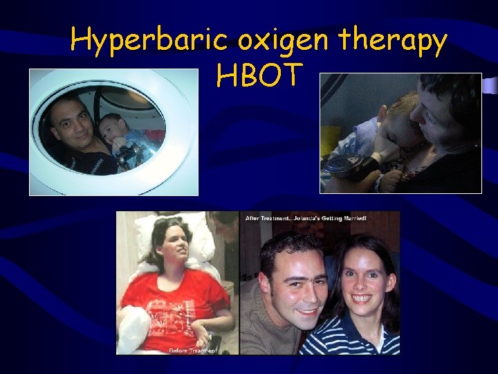 Hyperbaric oxigen therapy HBOT 