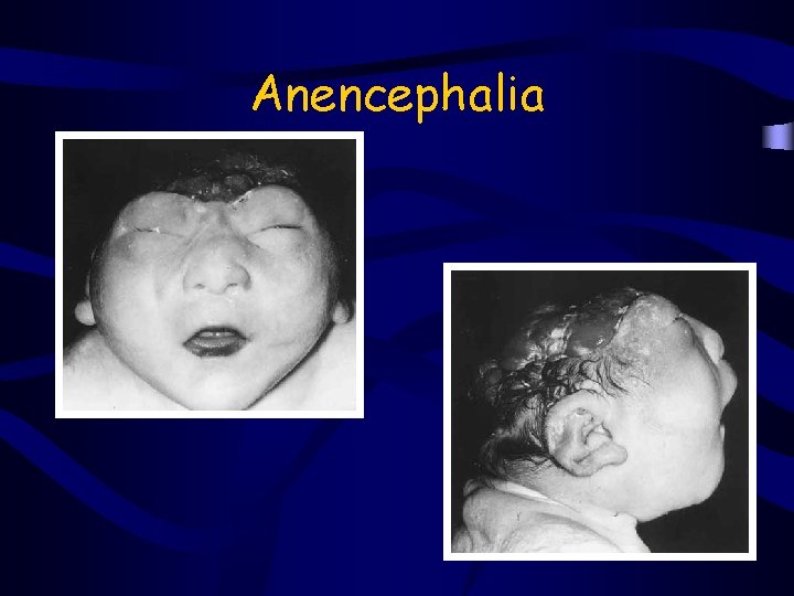 Anencephalia 