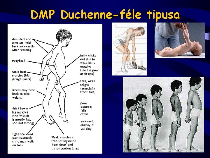DMP Duchenne-féle tipusa 