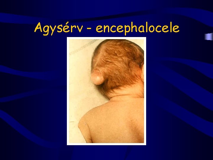 Agysérv - encephalocele 