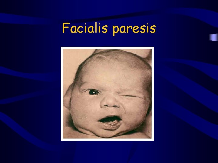 Facialis paresis 