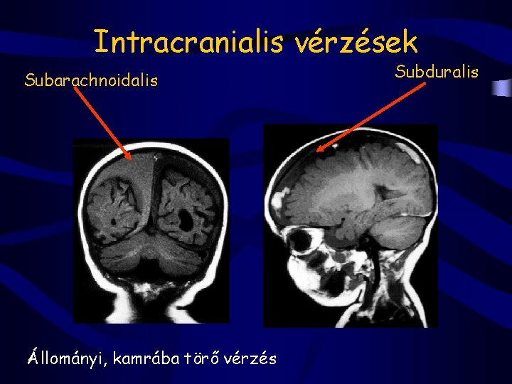 Intracranialis vérzések Subarachnoidalis Állományi, kamrába törő vérzés Subduralis 