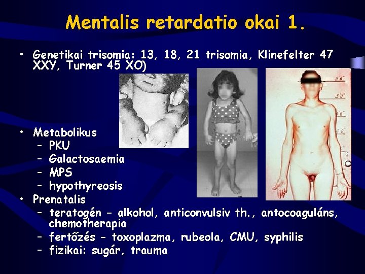 Mentalis retardatio okai 1. • Genetikai trisomia: 13, 18, 21 trisomia, Klinefelter 47 XXY,