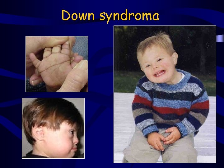 Down syndroma 