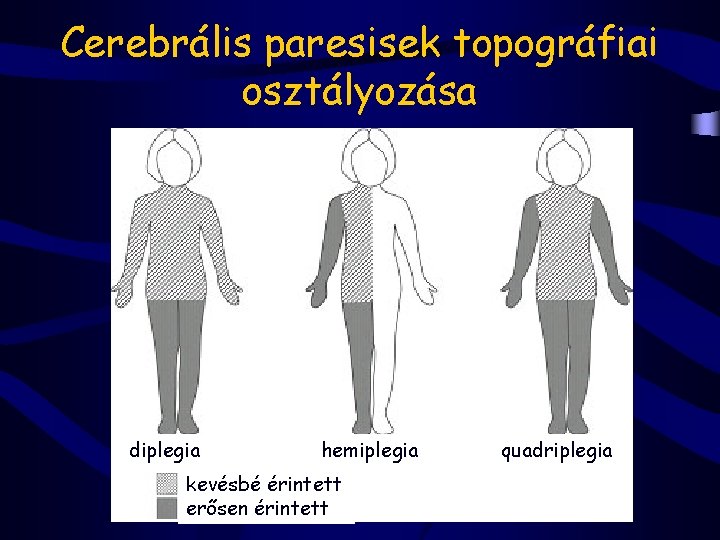 Cerebrális paresisek topográfiai osztályozása diplegia hemiplegia kevésbé érintett erősen érintett quadriplegia 