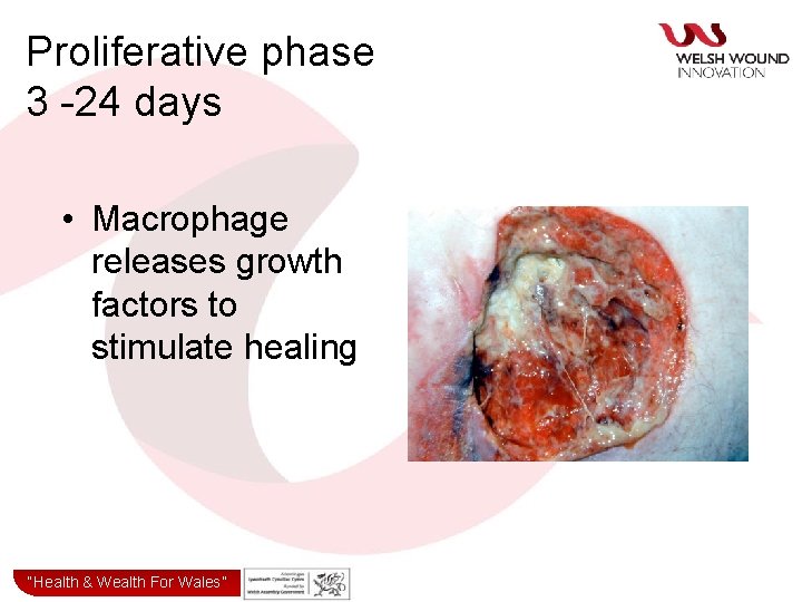 Proliferative phase 3 -24 days • Macrophage releases growth factors to stimulate healing “Health&