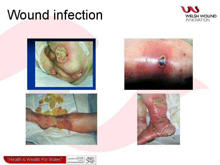 Wound infection “Health& & Wealth for Wales” “Health Wealth For Wales” 