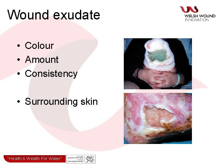 Wound exudate • Colour • Amount • Consistency • Surrounding skin “Health& & Wealth