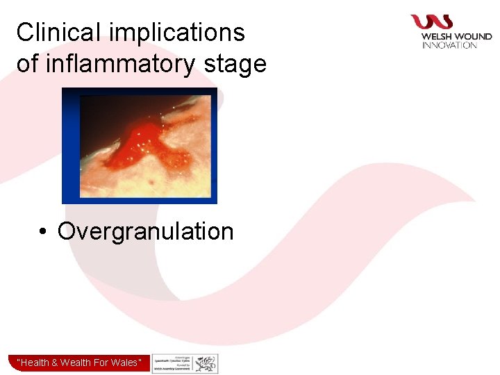 Clinical implications of inflammatory stage • Overgranulation “Health& & Wealth for Wales” “Health Wealth