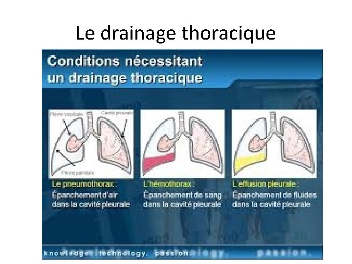 Le drainage thoracique 