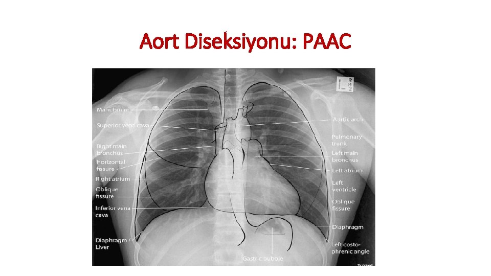 Aort Diseksiyonu: PAAC Aort Diseksiyonu: PAAC