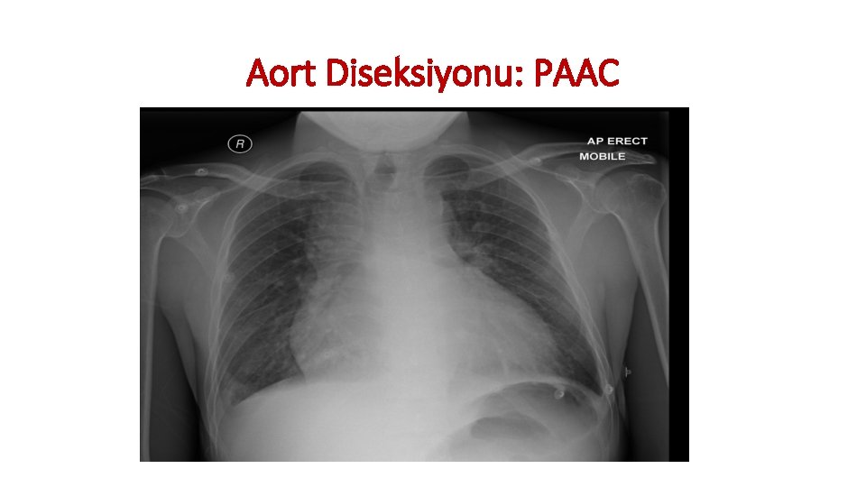 Aort Diseksiyonu: PAAC Aort Diseksiyonu: PAAC