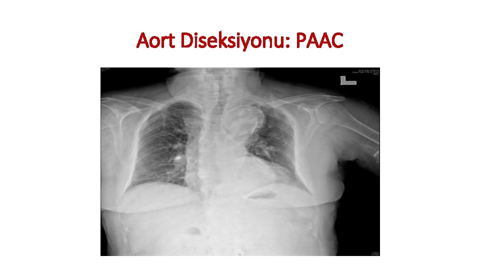 Aort Diseksiyonu: PAAC Aort Diseksiyonu: PAAC