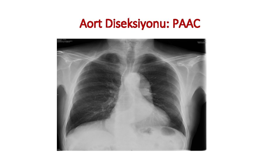 Aort Diseksiyonu: PAAC Aort Diseksiyonu: PAAC
