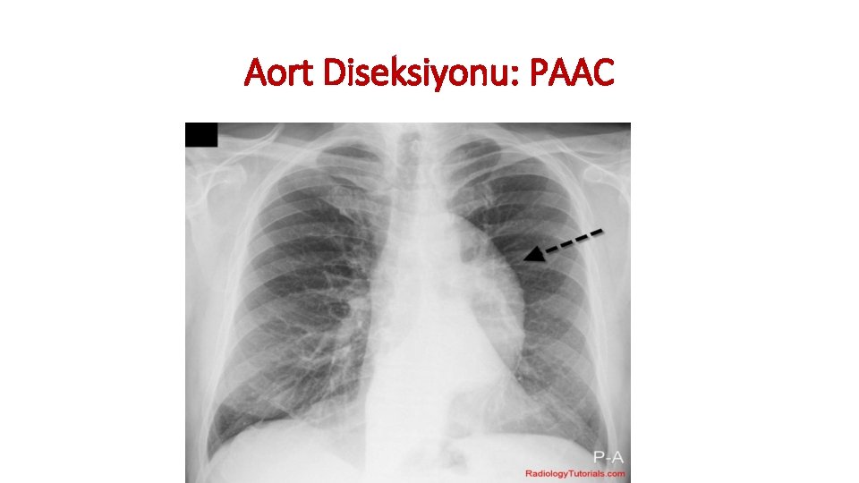 Aort Diseksiyonu: PAAC Aort Diseksiyonu: PAAC