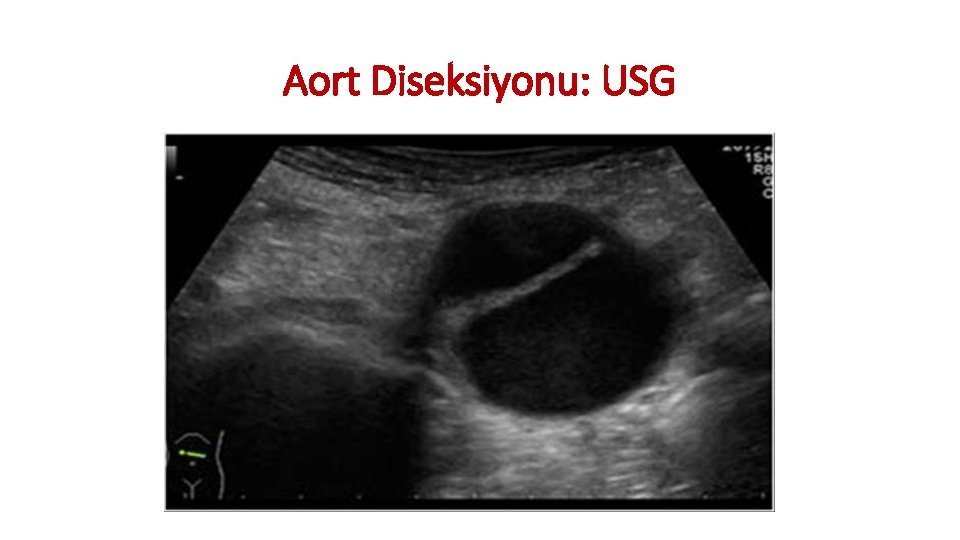 Aort Diseksiyonu: USG Aort Diseksiyonu: USG