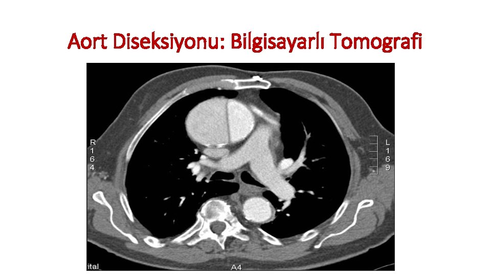 Aort Diseksiyonu: Bilgisayarlı Tomografi Aort Diseksiyonu: Bilgisayarlı Tomografi