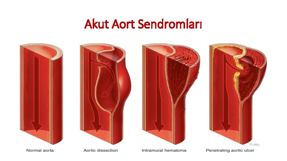 Akut Aort Sendromları Akut Aort Sendromları