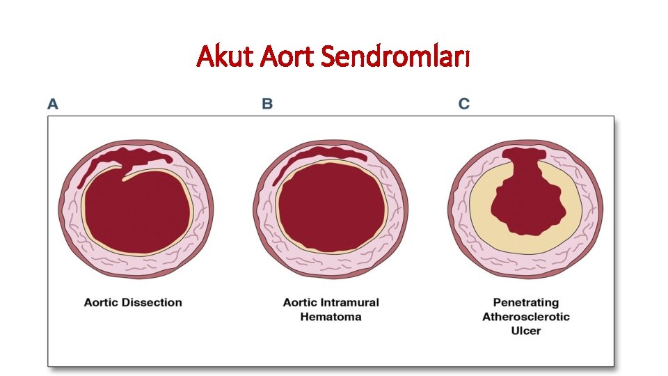 Akut Aort Sendromları Akut Aort Sendromları
