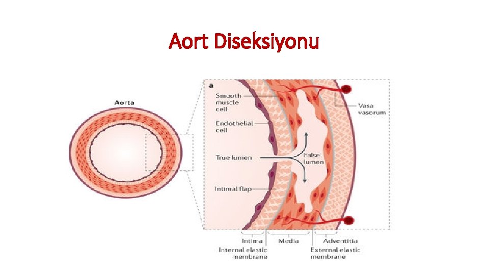 Aort Diseksiyonu Aort Diseksiyonu
