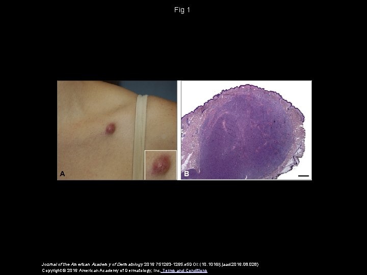 Fig 1 Journal of the American Academy of Dermatology 2016 751263 -1265. e 5