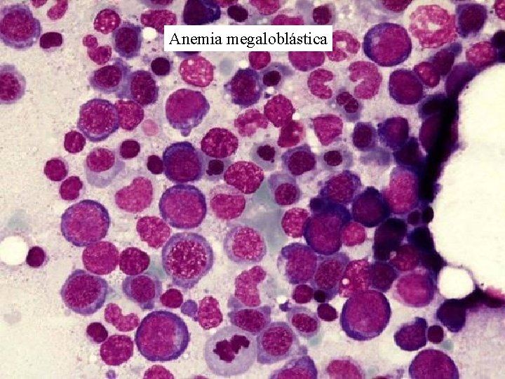 Anemia megaloblástica 
