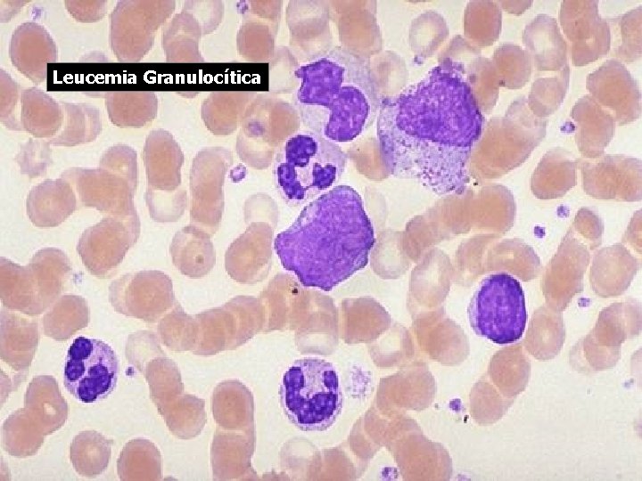 Leucemia Granulocítica 