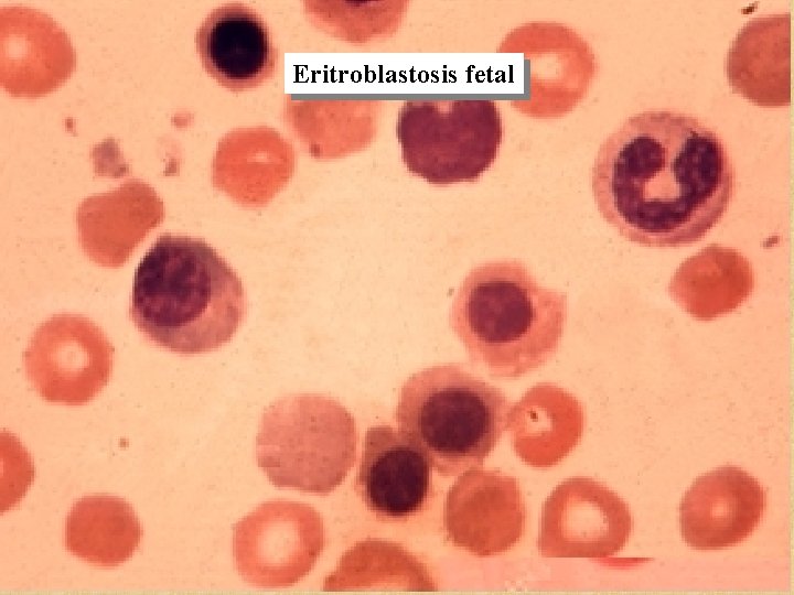 Eritroblastosis fetal 