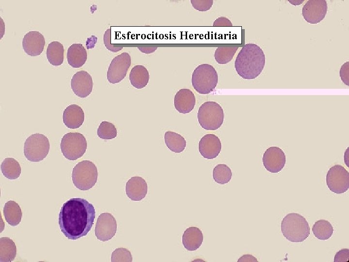 Esferocitosis Hereditaria 