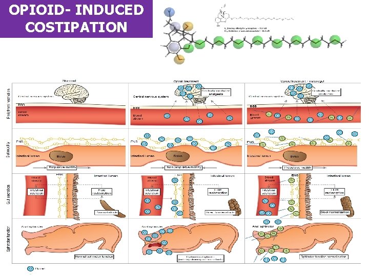 OPIOID- INDUCED COSTIPATION 