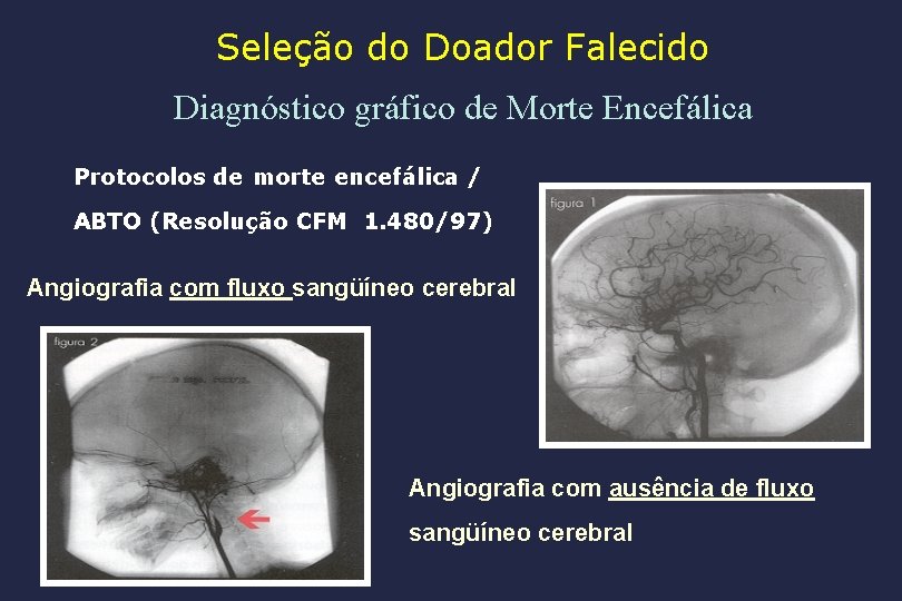 Seleção do Doador Falecido Diagnóstico gráfico de Morte Encefálica Protocolos de morte encefálica /