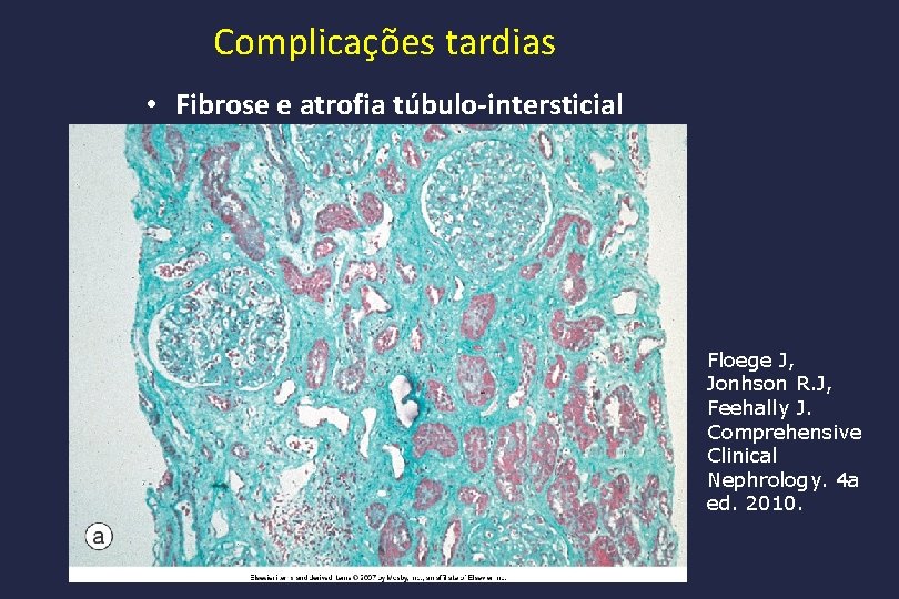Complicações tardias • Fibrose e atrofia túbulo-intersticial Floege J, Jonhson R. J, Feehally J.