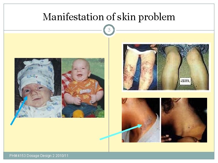 Manifestation of skin problem 3 PHM 4153 Dosage Design 2 2010/11 