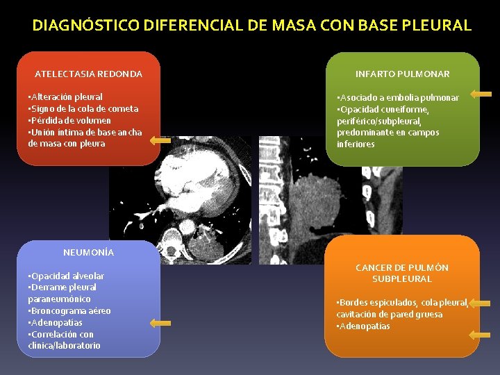 DIAGNÓSTICO DIFERENCIAL DE MASA CON BASE PLEURAL ATELECTASIA REDONDA • Alteración pleural • Signo