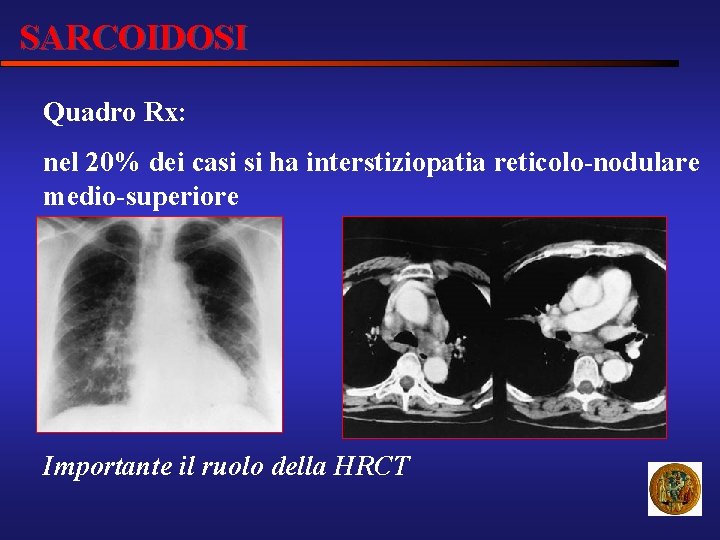 SARCOIDOSI Quadro Rx: nel 20% dei casi si ha interstiziopatia reticolo-nodulare medio-superiore Importante il