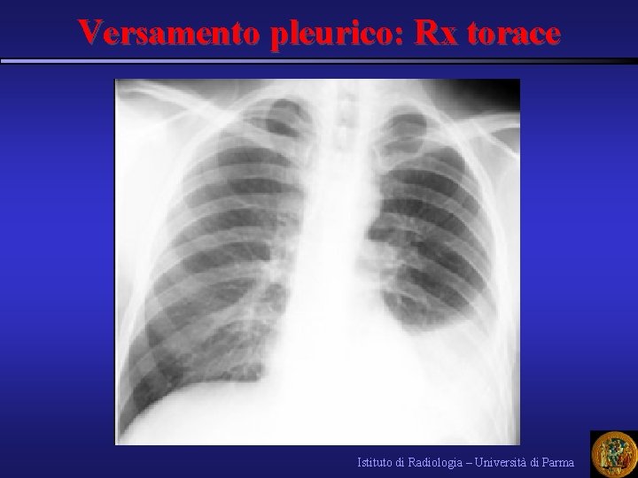 Versamento pleurico: Rx torace Istituto di Radiologia – Università di Parma 