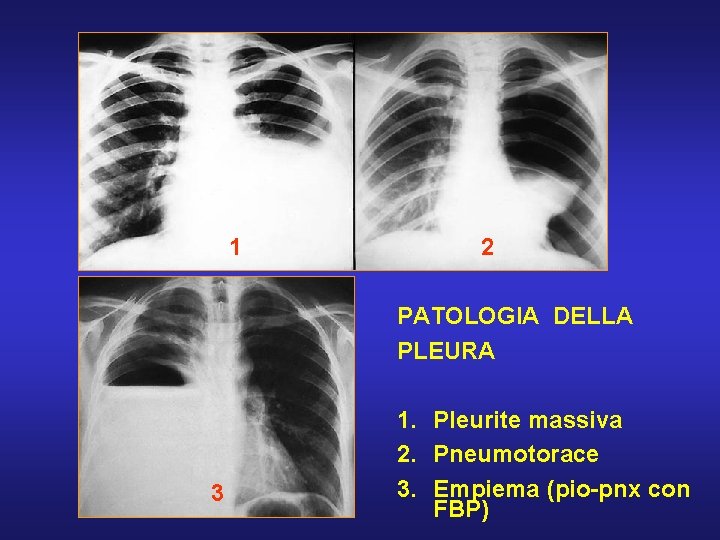 1 2 PATOLOGIA DELLA PLEURA 3 1. Pleurite massiva 2. Pneumotorace 3. Empiema (pio-pnx