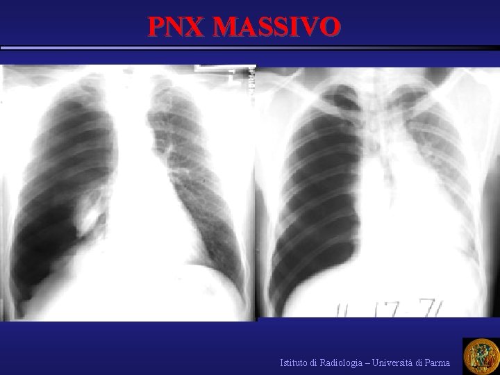PNX MASSIVO Istituto di Radiologia – Università di Parma 