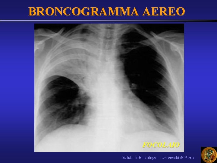 BRONCOGRAMMA AEREO FOCOLAIO Istituto di Radiologia – Università di Parma 