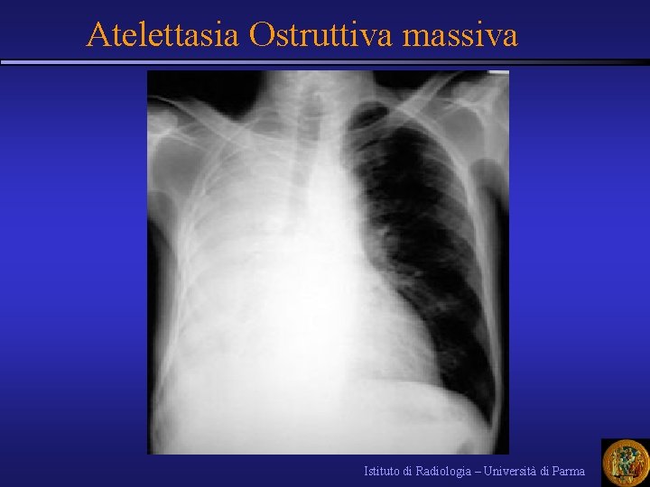 Atelettasia Ostruttiva massiva Istituto di Radiologia – Università di Parma 