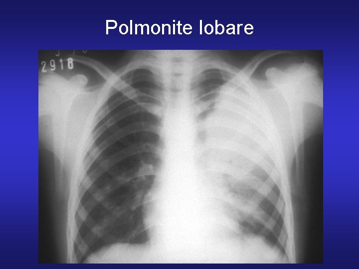 Polmonite lobare 