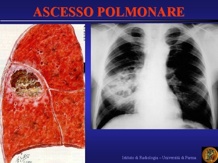 ASCESSO POLMONARE Istituto di Radiologia – Università di Parma 