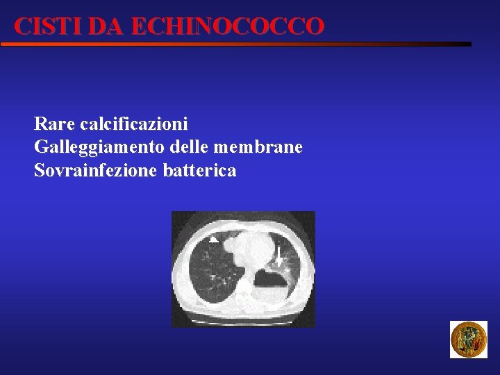 CISTI DA ECHINOCOCCO Rare calcificazioni Galleggiamento delle membrane Sovrainfezione batterica 