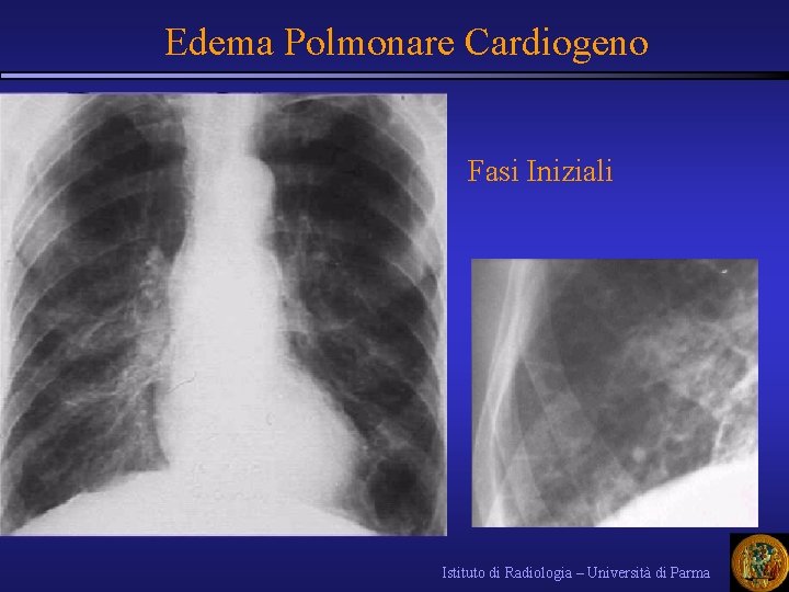 Edema Polmonare Cardiogeno Fasi Iniziali Istituto di Radiologia – Università di Parma 