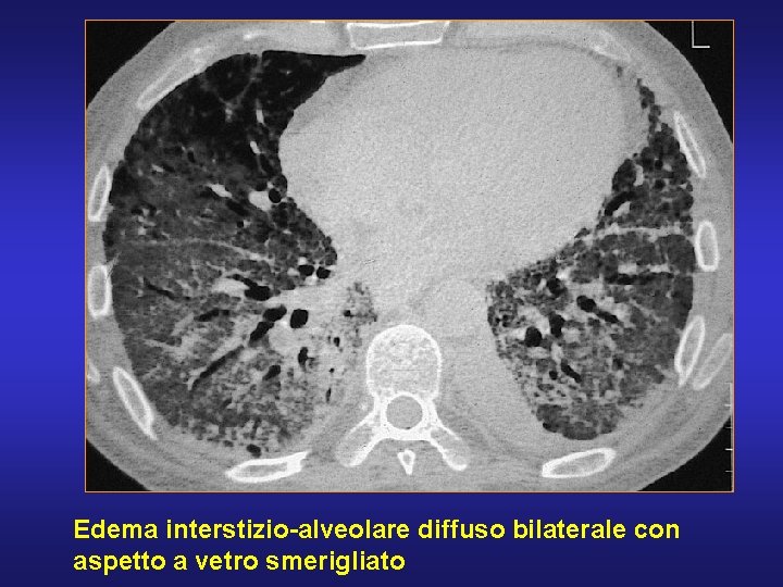 Edema interstizio-alveolare diffuso bilaterale con aspetto a vetro smerigliato 